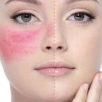 550x394xrosacea.jpg.pagespeed.ic.ES-VWPM2xr