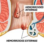 almorranas-hemorroides