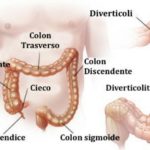 diverticulitis